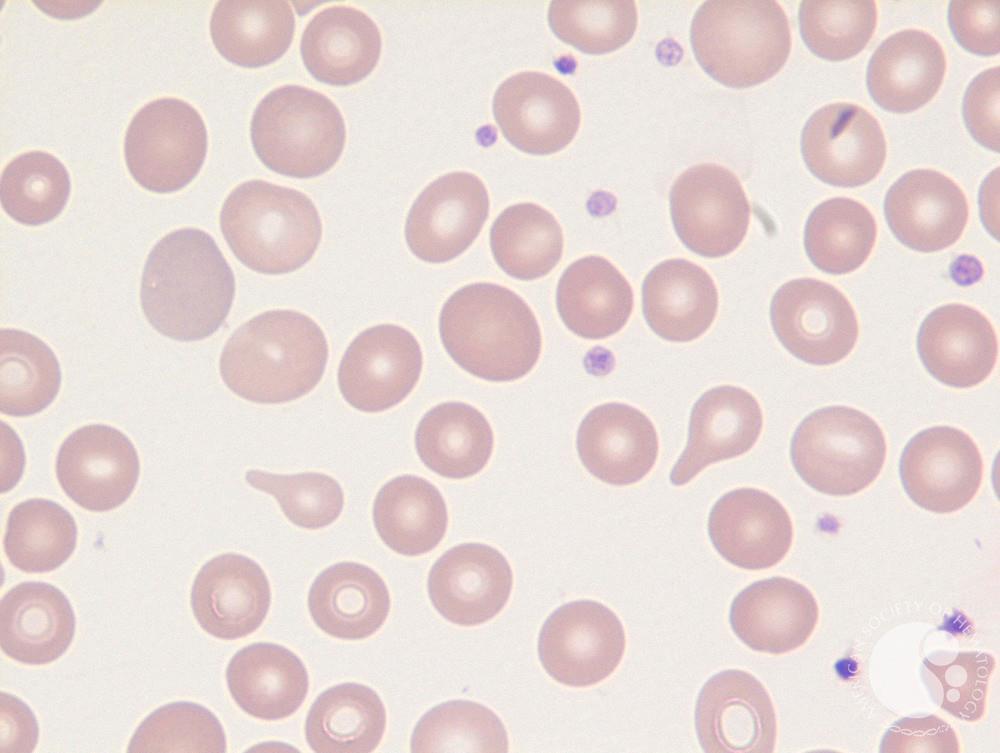 Blood-Tear Drop cells