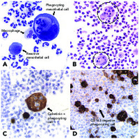Differentiation of mesothelial cells into macrophage phagocytic cells in a patient with clinical sepsis