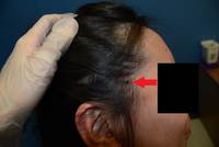 Current-Classification-WHO-2016-of-EBv-Tcell-and-NKcell-Proliferations