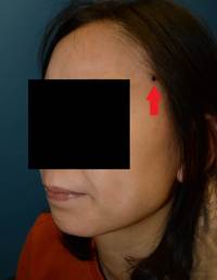 Current-WHO-2016-Classification-of-EBV-Tcell-and-NKcell-Proliferations