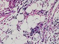 Current-WHO-2016-Classification-of-EBV-Tcell-and-NKcell-Proliferations