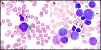 lgl leukemia icd 9 code