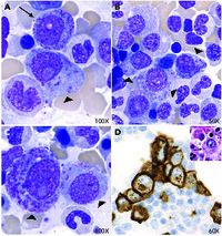 Neoplastic plasma cells with azurophilic crystalline inclusions mimicking promyelocytes