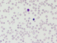 BEta-thalassemia major