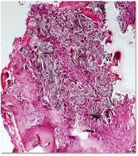Oxalate crystals in bone marrow 1