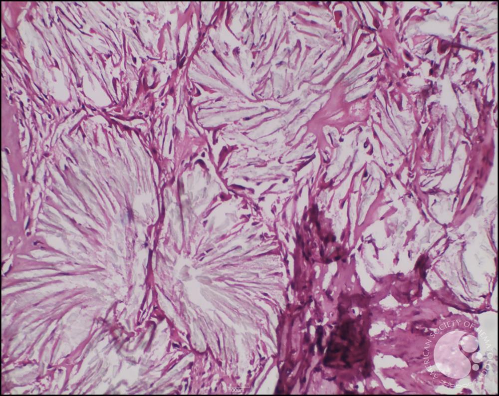 Oxalate crystals in bone marrow 2