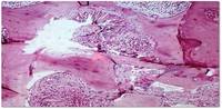 Oxalate crystals in bone marrow 4