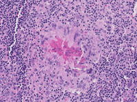 Kimuras Disease 4