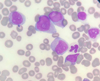 Acute myeloblastic leukemia (AML-M2) 4