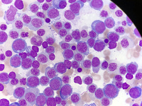 Pure Erythroid Leukemia 1