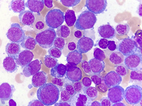 Pure Erythroid Leukemia 2