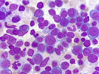 Pure Erythroid Leukemia 3