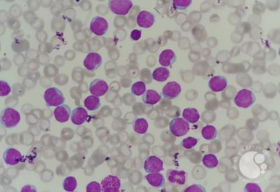 Chronic lymphocytic leukemia (CLL) with presence of pro-lymphocytes 1