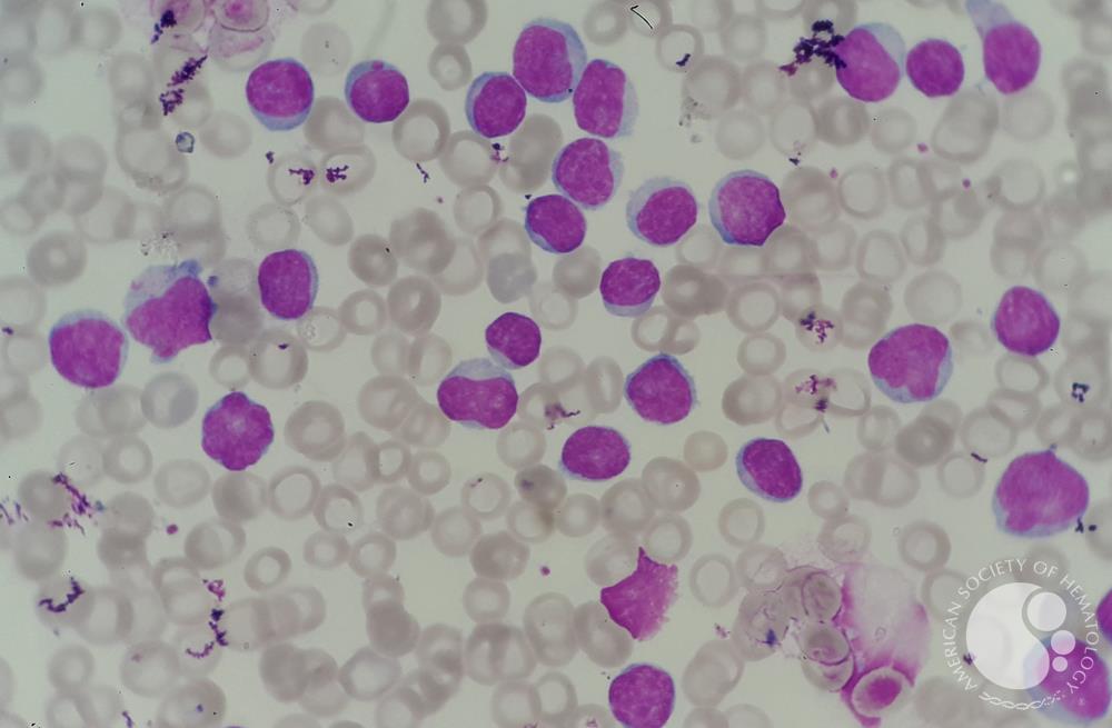Chronic lymphocytic leukemia (CLL) with presence of pro-lymphocytes 2