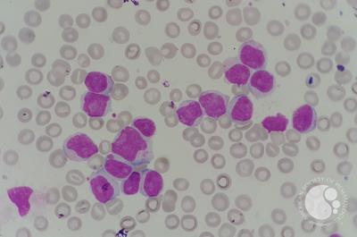 Chronic lymphocytic leukemia (CLL) with presence of pro-lymphocytes 4