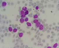 leukemia chronic lymphocytic cll lymphocytes pro presence hematology prolymphocytes imagebank