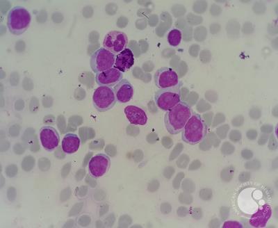 Chronic lymphocytic leukemia (CLL) with presence of pro-lymphocytes 5
