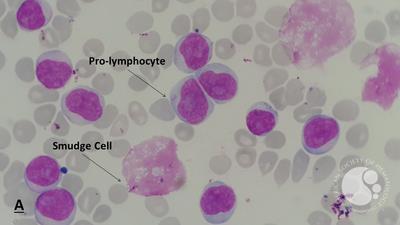 Chronic lymphocytic leukemia (CLL) with presence of pro-lymphocytes 6