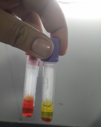 Instant Haemolysis by Complement activation due to High Titre Cold Agglutinins