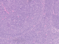Lymph node with metastatic spindle cell melanoma