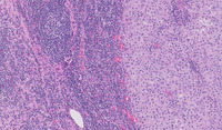 Lymph node with metastatic melanoma