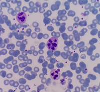 Hypersegmented neutrophil