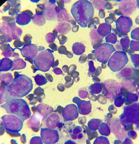 megaloblastic-anemia-1