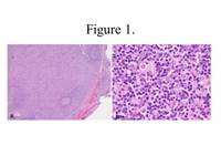 Systemic EBV+ T-cell Lymphoma: H&E