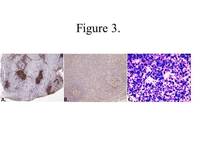 Systemic EBV+ T-cell Lymphoma: CD20, PD-1, & EBER