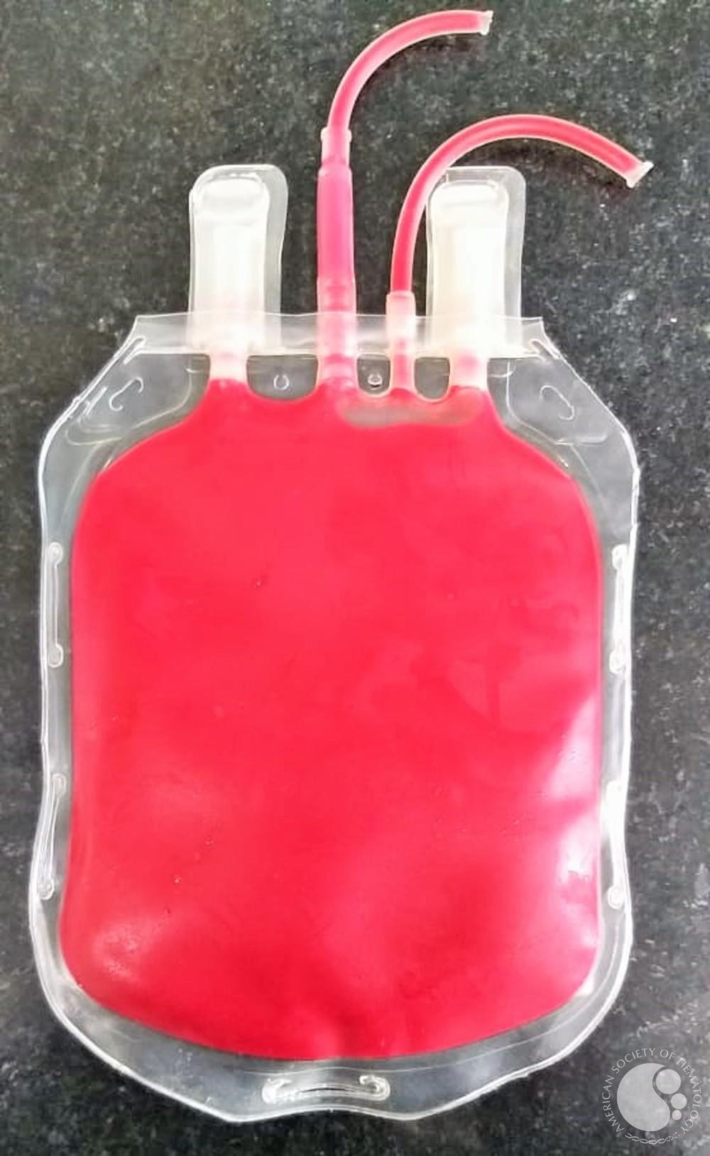 Cherry Red Discoloration of Blood Unit