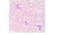 Pseudo-thrombocytopenia in a Healthy Whole Blood Donor