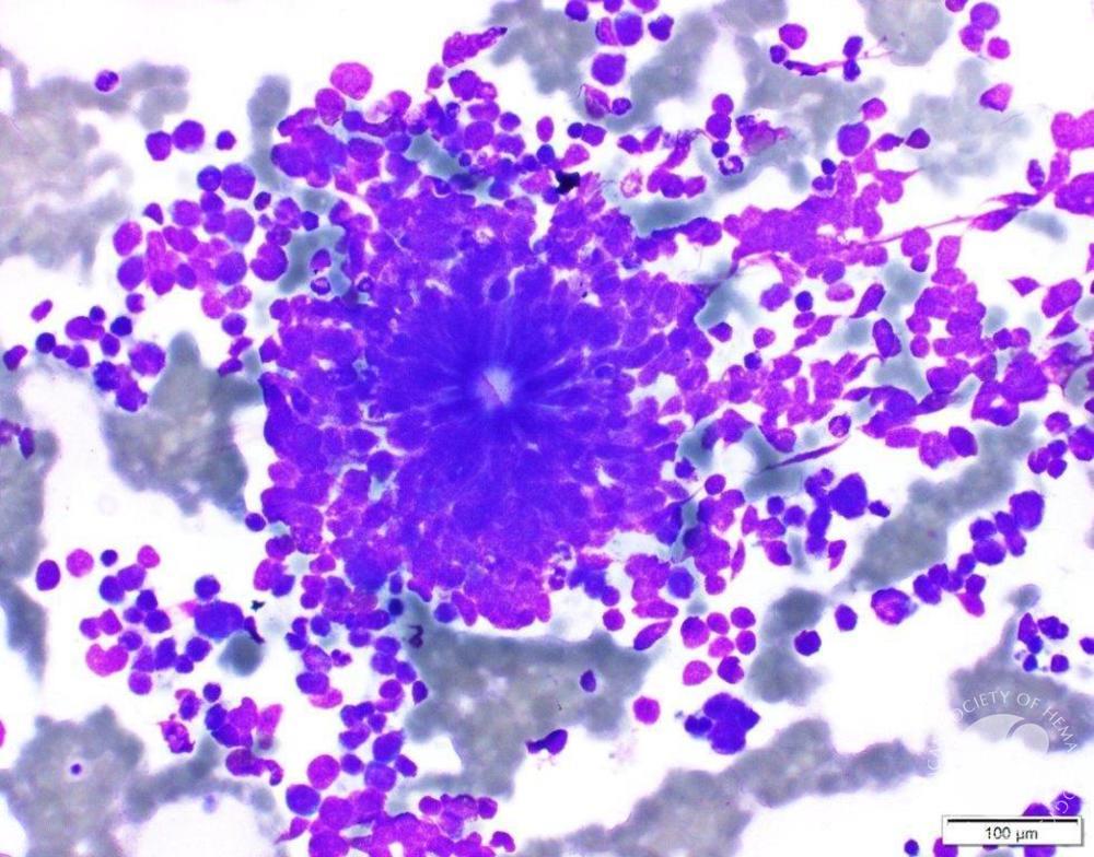 Neuroblastoma rosette in the bone marrow aspirate smear