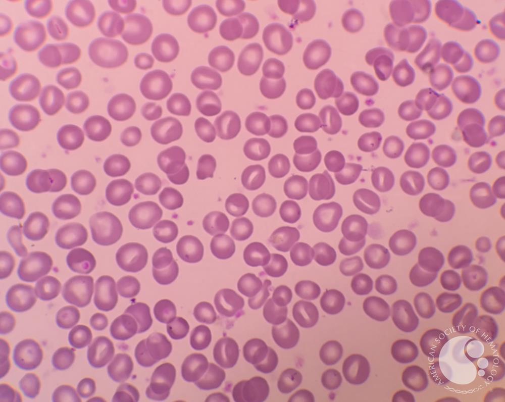 Stomatocytosis in peripheral blood smear 1