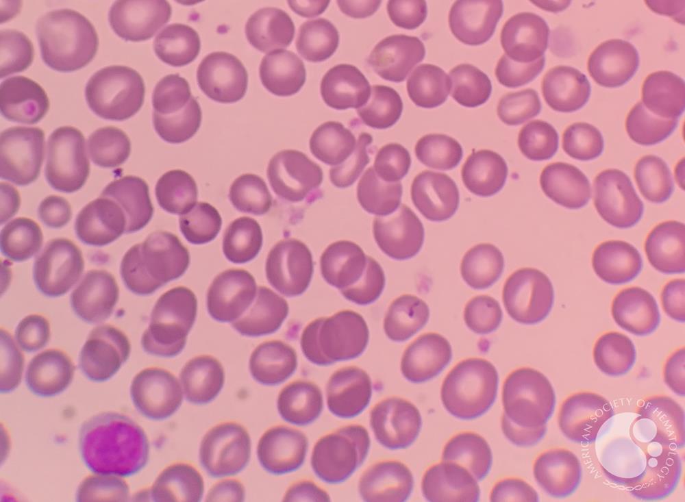 Stomatocytosis in peripheral blood smear 2