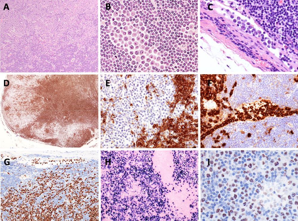 Nodal extracavitary variant of primary effusion lymphoma as complication of chronic lymphocytic leukemia: a previously unreported type of Richter’s syndrome