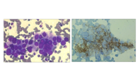 Synaptophysin IHC on a neuroblastoma aggregate in bone marrow aspirate smear