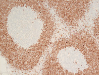 Mantle cell lymphoma with mantle zone pattern-3