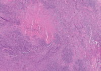 Prominent large eosinophilic abscess