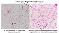 atypical-microangiopathic-hemolytic-anemia-case-report