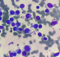 Metastatic Neuroblastoma Aspirate Smear