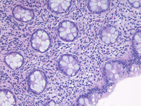 Mastocytosis H&E Intermediate Power