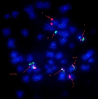 Metaphase FISH image using BCR/ABL1 dual colour dual fusion probe+ Centromere enumeration probe for chromosome 12+ del(7q) triple colour deletion probe