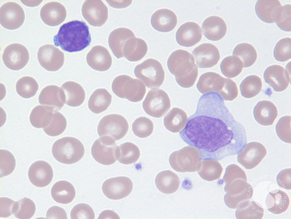 Mycosis Fungoides Blood