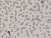 Rouleaux in Myeloma