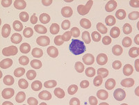 splenic marginal zone lymphoma