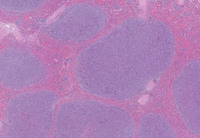 splenic marginal zone lymphoma