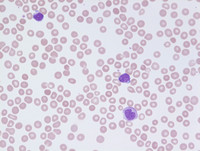 Refractory Cytopenia of Childhood