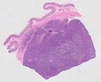 Double Hit Lymphoma-H&E Low Power