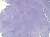 Follicular Lymphoma Grade 3a-H&E