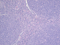 Follicular Lymphoma Grade 3aH&E